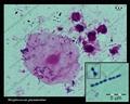 s.pneumoniae in sputum, Gram stain